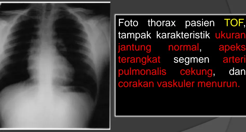 Foto  thorax  pasien  TOF ,  tampak  karakteristik  ukuran  jantung  normal,  apeks  terangkat  segmen  arteri  pulmonalis  cekung,  dan  corakan vaskuler menurun