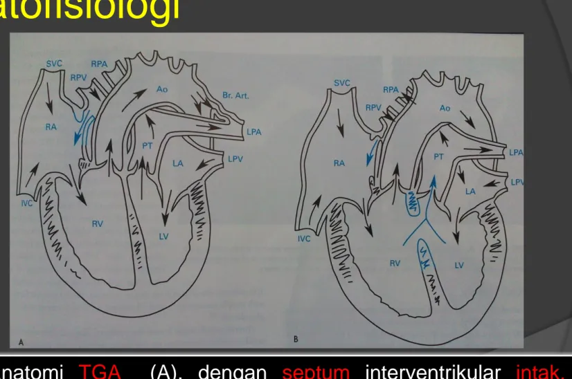 Diagram  anatomi  TGA     (A),  dengan  septum  interventrikular  intak,  PFO,  pelebaran arteri bronchialis