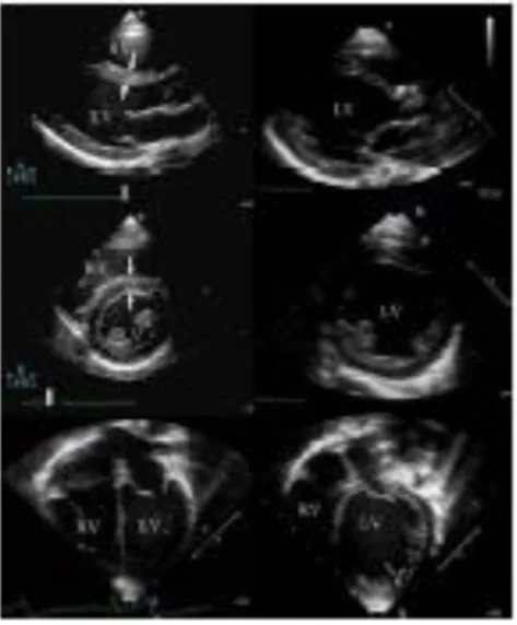 Gambar 3. Beberapa hasil ekokardiografi dari jantung normal (kiri) dan jantung  dengan kardiomiopati dilatasi (kanan)