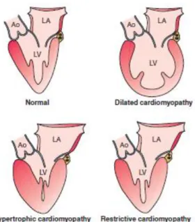 Gambar 1. Perbandingan morfologi jantung pada kardiomiopati  7