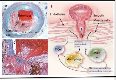 Gambar 1.1 Lesi Aterosklerotik Pada arteri manusia  tempat pecahnya plaprothrombotik dan prokoagulan yang secara langsung mempercepat pembentukan thrombus pada mengaktifasi sel T, Makrofag dan sel mast yang mengakibatkan sekresi dari sitokin inflamari(mis