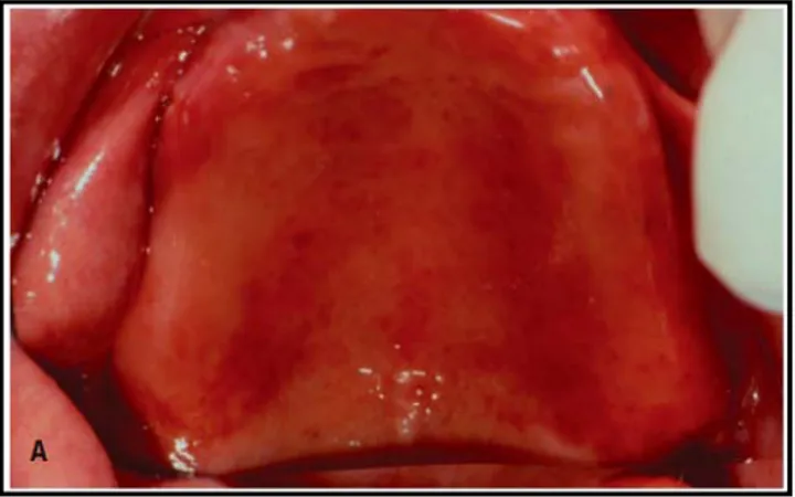 Gambar 6. Denture stomatitis pada palatum 2 