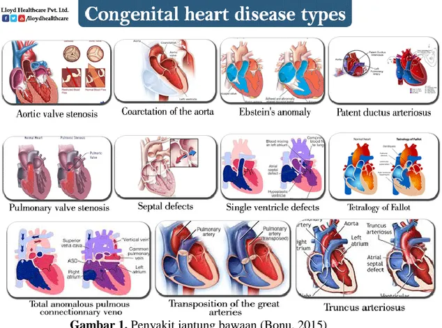 Gambar 1. Penyakit jantung bawaan (Bonu, 2015)  1.  PENYAKIT JANTUNG BAWAAN NON-SIANOTIK 