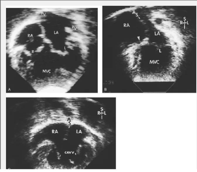 Gambar 2. Ekokardiografi pada a) double inlet ventricle, B) single inlet ventricle dan C) Common AV valve.