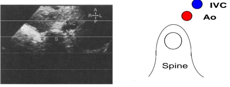Gambar 6. Situs ambigus vena kava inferior di anterior-lateral, aorta desenden berjalan berdampingan di kanan atau kiri vertebra