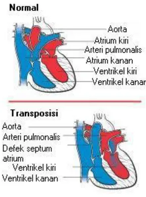 Gambar 1.Transposisi Arteri Besar (2) 