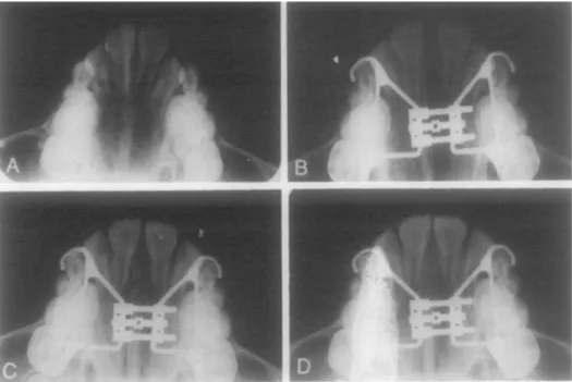 Gambar 11. A. Foto oklusal maksila, B. Ekspansi sutura midpalatal pada area                      radiolucent, C