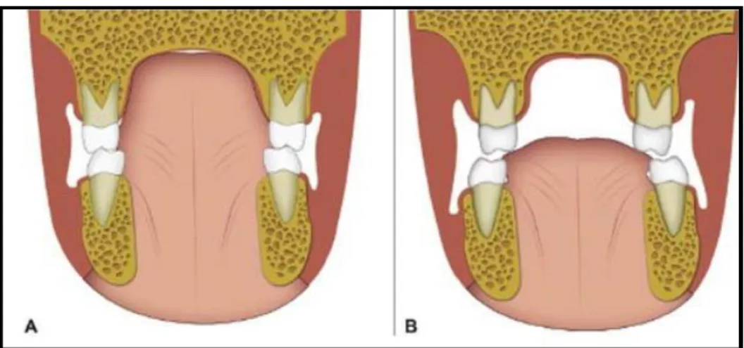 Gambar 2.4. A.Posisi lidah normal, B. Posisi lidah kebawah   sebagai kompensasi bernafas melaui mulut