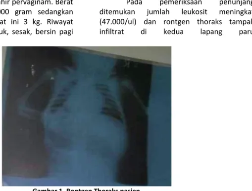 Gambar 1. Rontgen Thoraks pasien Pembahasan 