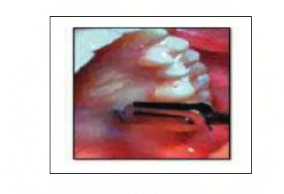 Gambar 1.    Harris  double   blade.  The   Subepithelial   connective   tissue   graft:   Part  1   Patient                         selection     and    surgical   techniques