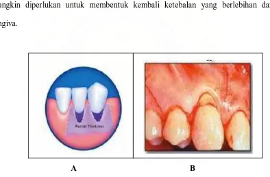 Gambar 2.  Teknik Langer dan Langer (A) Desain flep  (B) gambaran klinik. The Subepithelial                       <http:// www.Thejcdp.com/ issue021/sedon