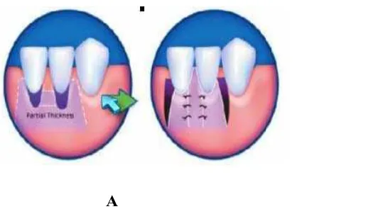 Gambar 6.   Teknik Blanes dan Allen   (A)  desain flep  (B)  gambaran klinik.  The  Subepithelial                         connective      tissue     graft  :    Part 1