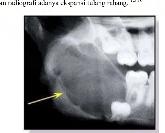 Gambar 6. Odontogenik keratokista bentuk unilocular pada regio molar tiga impacted. 16 