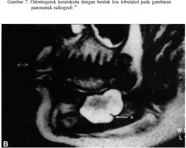 Gambar 7. Odontogenik keratokista dengan bentuk lesi lobulated pada gambaran panoramik radiografi 16 