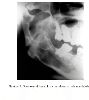 Gambar 9. Odontogenik keratokista multilokuler pada mandibula 16 
