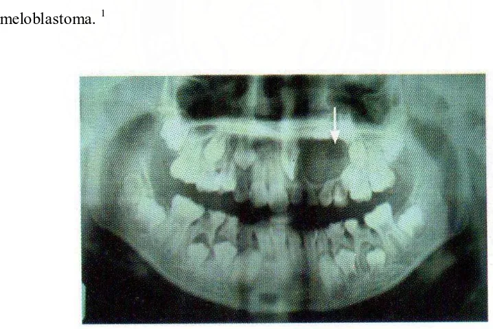 Gambar 13.   Odontogenik berkalsifikasi pada maksila disertai gigi kaninus kiri atas impaksi