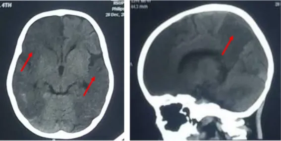 Gambar 1.   Gambaran edema serebri dan brain iskemi pada lobus frontal dextra  serta temporoparietal bilateral 