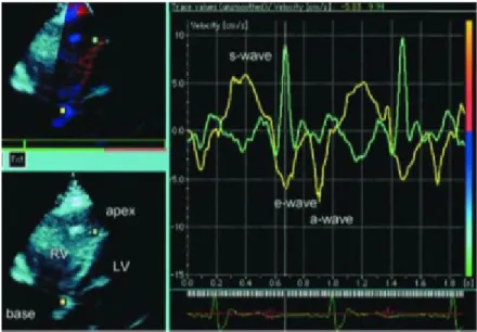 Gambar 2.3 Suatu   pemeriksaan   echocardiogram   Doppler   jaringan menunjukkan   perubahan   warna   dari   biru   ke   merah   pada septum   miokardial   sebagai   tanda   adanya   deposisi besi.Terbaliknya   gelombang   s  dan   e   pada   apeks   mena