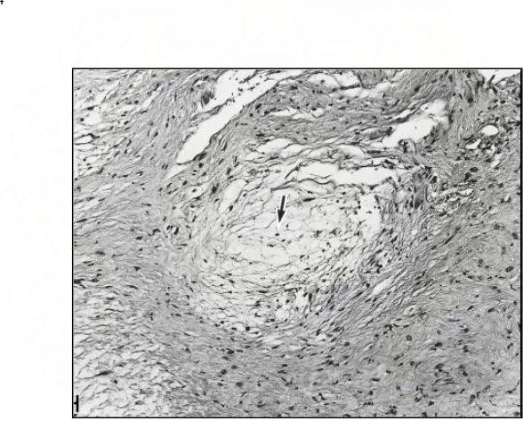 Gambar 4.  Antony tipe B hiposelular, mengandung cairan edema, kurang tersusun dimana sel-sel spindel tersebar luas dengan stroma myxomatous longgar 13 