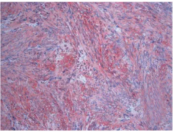 Gambar 5. Sel-sel tumor menunjukkan immunopositivity terhadap protein S-100.2 