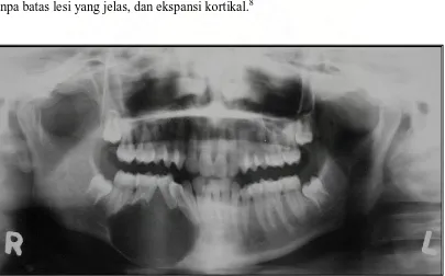 Gambar 6. Gambaran panoramik menunjukkan perluasan tumor dari premolar pertama kanan  bawah hingga molar kedua.16  
