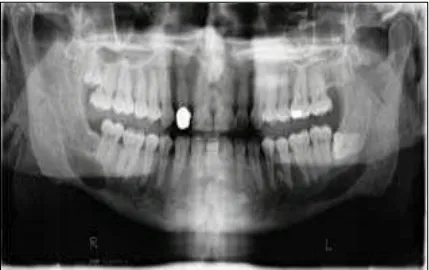 Gambar 7. Intraosseus neurilemmoma bilateral berupa gambaran radiolusensi soliter pada kedua  sisi mandibula berkaitan dengan kanalis alveolaris inferior.17 