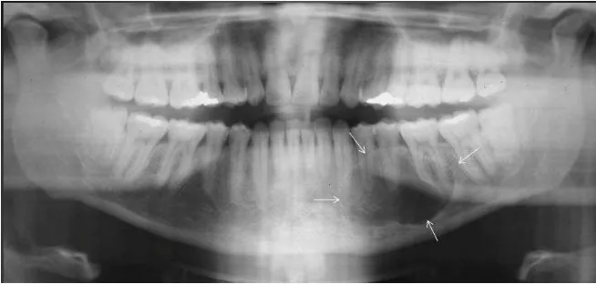 Gambar 10. (a) Angioma dekat kanal alveolar menyerupai neurilemmoma.         (b) Periodontal cyst dengan bentuk radiolusensi unilokular.21 