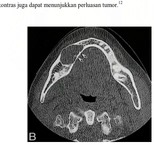 gambaran incomplete bone septae.6,13 Selain itu, pemeriksaan radiografis intraosseus 