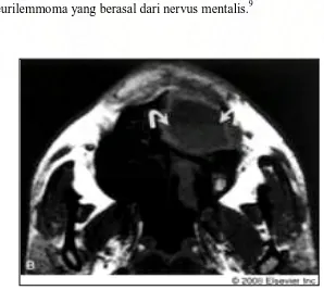 Gambar 14. Gambar Axial T1-weighted MR image menunjukkan  asal lesi dan mendemonstrasikan level fluid di  dalamnya (tanda panah).22 