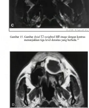 Gambar 15. Gambar Axial T2-weighted MR image dengan kontras  menunjukkan tiga level densitas yang berbeda.22 