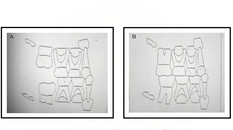 Gambar 2.  Fase transisi pertama pada geligi posterior  