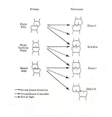 Gambar 3.  Hubungan oklusi gigi molar desidui dan permanen pada fase transisi6 