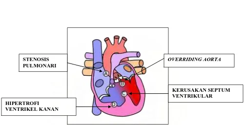 Gambar 1.   Malformasi pada empat bagian jantung yang mana terjadi bersamaan pada pasien dengan kelainan jantung kongenital TOF 9 