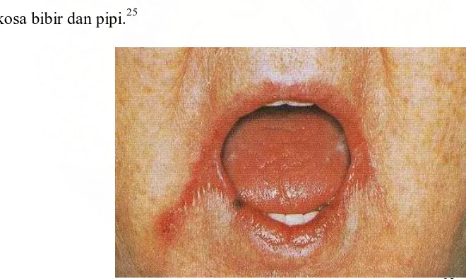 Gambar 7. Angular cheilitis pada sudut mulut 25  