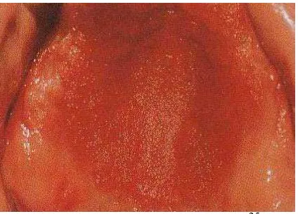 Gambar 12. Denture stomatitis 32  