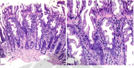 Gambar  II.1.  Polip  hiperplastik  (PH).  A  dan  B.  Kripta  pada  mukosa  usus  besar  dengan  inti sel kecil dan padat di bagian bawah lamina propria, dengan pelebaran kripta dibagian  permukaan (pembesaran 100x)