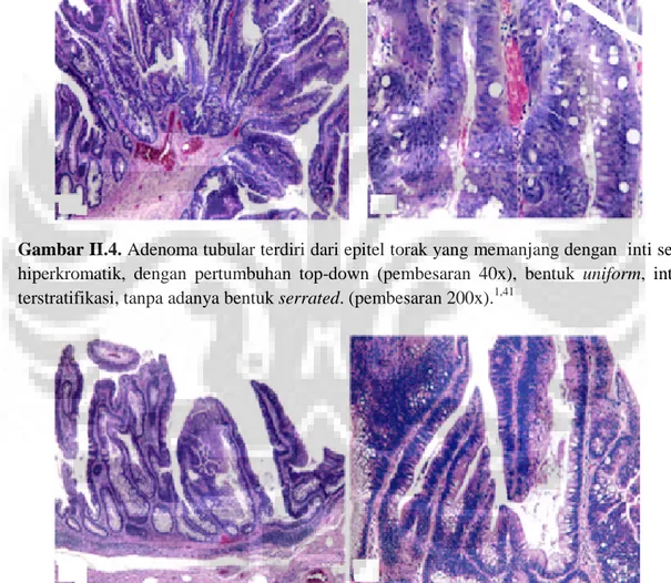 Gambar  II.5.  Adenoma  villosum,  dengan  inti  sel  displastik,  uniform,  hiperkromatik  (pembesaran  40x),  dengan  gambaran  selular  dan  tidak  terdapat  gambaran  serrated  (pembesaran 200x)
