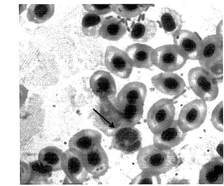 Gambar 10 Sel PMN yang sedang memfagosit bakteri E.  coli  (perbesaran objektif 100x) 
