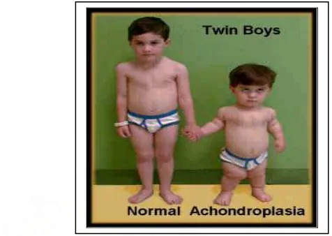 Gambar  3: Anak kembar, normal (kiri), Achondroplasia (kanan)11 
