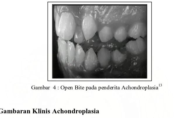 Gambar  4 : Open Bite pada penderita Achondroplasia 