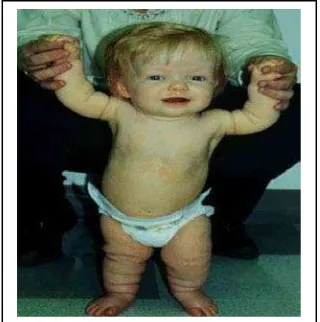 Gambar 9 : Kulit berlebih pada kaki bayi yang terkena Achondroplasia 