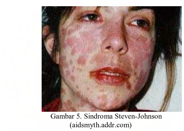 Gambar 5. Sindroma Steven-Johnson (aidsmyth.addr.com) 