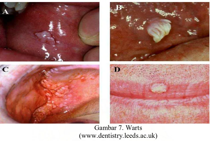 Gambar 7. Warts (www.dentistry.leeds.ac.uk) 