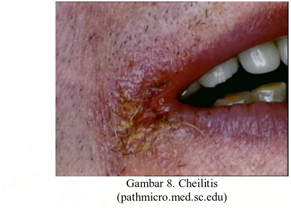 Gambar 8. Cheilitis (pathmicro.med.sc.edu) 