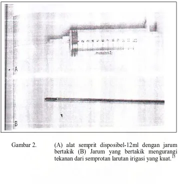 Gambar 2. (A) alat semprit disposibel-12ml dengan jarum bertakik (B) Jarum yang bertakik mengurangi tekanan dari semprotan larutan irigasi yang kuat.15 
