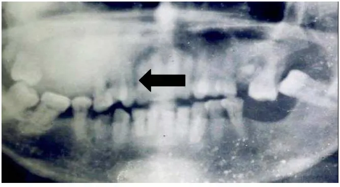 Gambar 7. Radiografi panoramik menunjukkan gambaran ground glass dengan batas 11