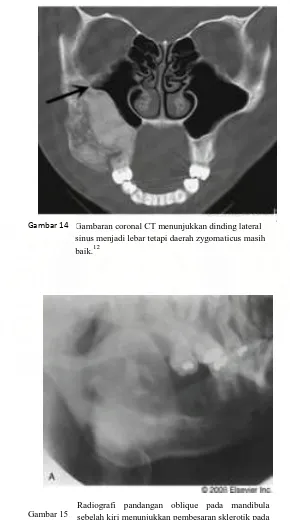 Gambaran coronal CT menunjukkan dinding lateral sinus menjadi lebar tetapi daerah zygomaticus masih 