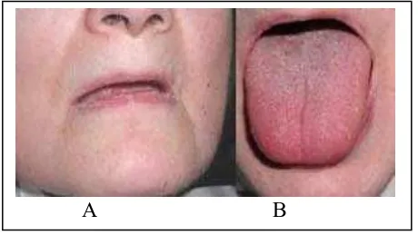 Gambar 2.Pasien penderita Xerostomia            A. Bibir yang kering dan pecah            B