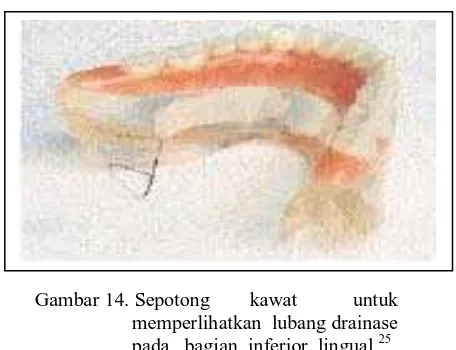 Gambar 14. Sepotong        kawat           untuk             memperlihatkan  lubang drainase            pada   bagian  inferior  lingual.25   