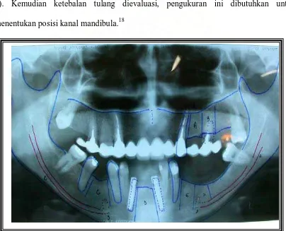 Gambar 5. Foto panoramik prabedah. Lopes J, Clovis, Leonardo J. Lower alveolar blundle nervus transposition  for implan fixation